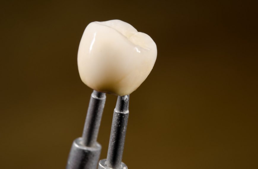 dental implant